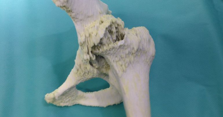 Primera operación con éxito en Castilla y León utilizando las 3 dimensiones: El 3D llega a los quirófanos Primera operación con éxito en Castilla y León utilizando las 3 dimensiones: El 3D llega a los quirófanos
