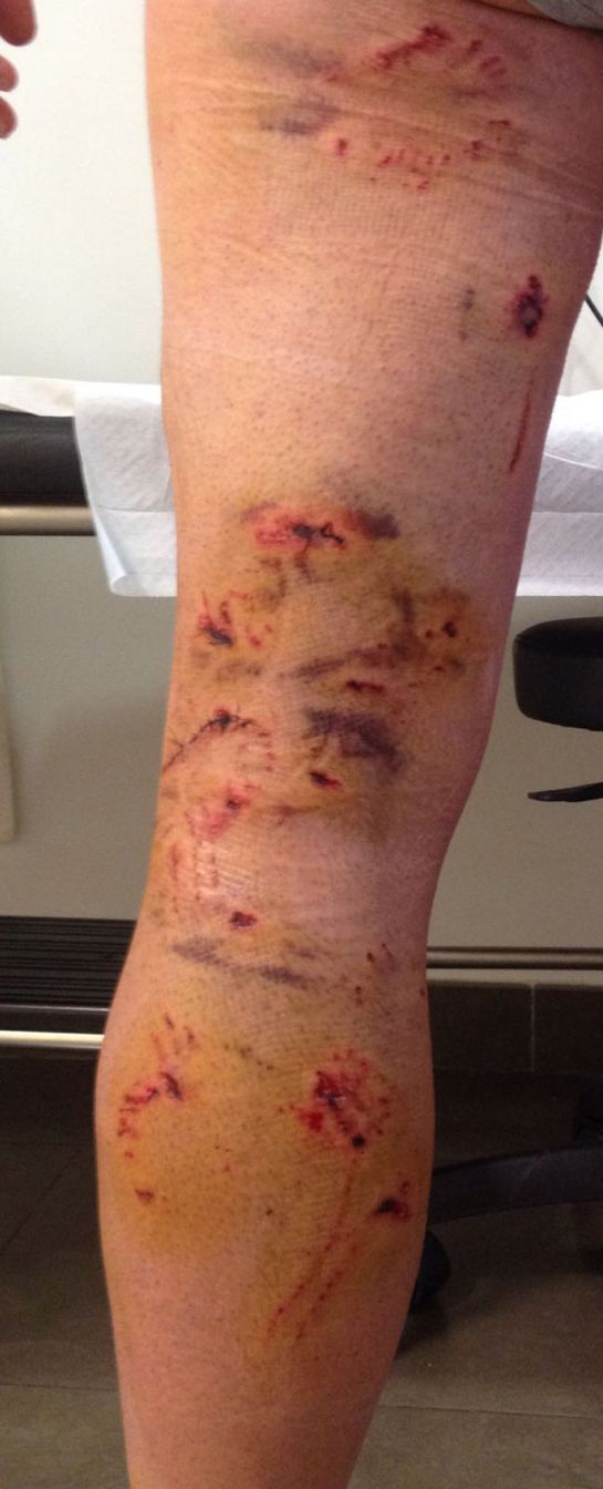 Heridas en las piernas Heridas en las piernas