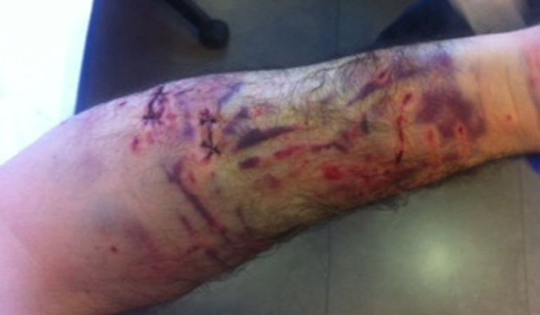 Las heridas en brazos y piernas requieren de curas diarias Las heridas en brazos y piernas requieren de curas diarias