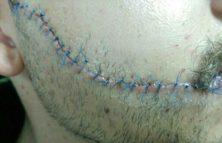 Herida sufrida por una de las víctimas del ataque Herida sufrida por una de las víctimas del ataque