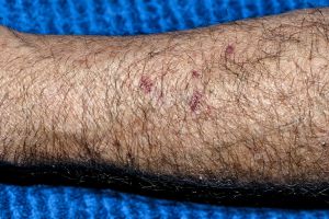 Efectos de la radiación en los capilares del brazo de Vicente García Efectos de la radiación en los capilares del brazo de Vicente García