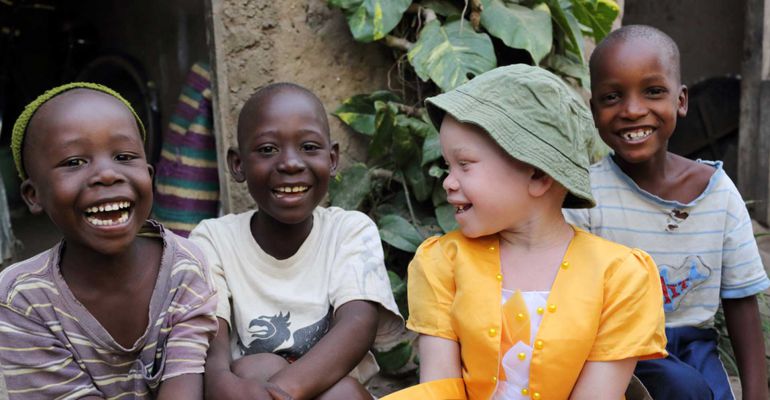 Albinos, el infierno africano de los inocentes Albinos, el infierno africano de los inocentes