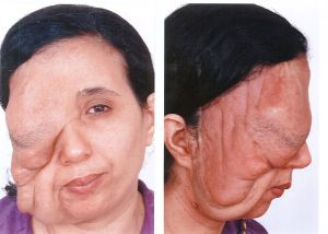 Imagen facilitada por el Hospital de Manises de Samira Benhar, una mujer marroquí afectada por una severa deformidad debida a un tumor facial, que le acarreaba rechazo social en su país, antes de ser sometida a la operación de reconstrucción del rostro que le practicó el doctor Pedro Cavadas en el Hospital de Manises (Valencia) gracias a la colaboración de la Fundación Adra y el Centro Islámico de Valencia. Imagen facilitada por el Hospital de Manises de Samira Benhar, una mujer marroquí afectada por una severa deformidad debida a un tumor facial, que le acarreaba rechazo social en su país, antes de ser sometida a la operación de reconstrucción del rostro que le practicó el doctor Pedro Cavadas en el Hospital de Manises (Valencia) gracias a la colaboración de la Fundación Adra y el Centro Islámico de Valencia.