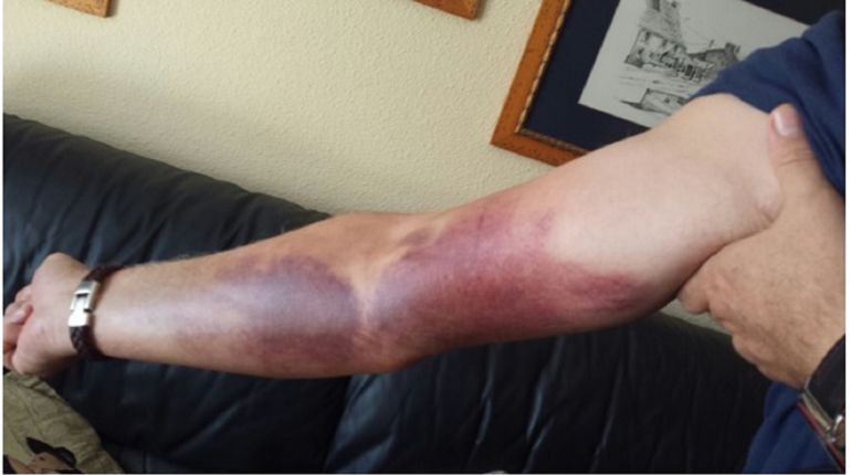 Hematomas en el brazo de uno de los agredidos Hematomas en el brazo de uno de los agredidos