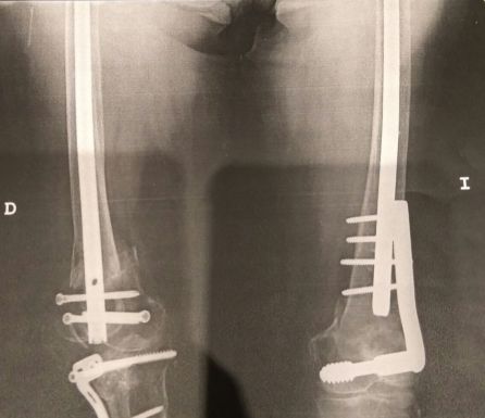 Radiografía de Mercedes tras operarse por rotura de las dos rodillas y un fémur Radiografía de Mercedes tras operarse por rotura de las dos rodillas y un fémur