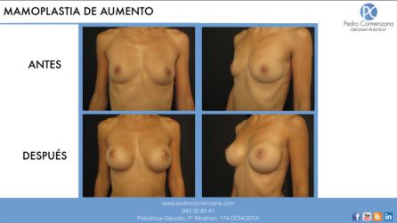 Mamoplastia de aumento Mamoplastia de aumento