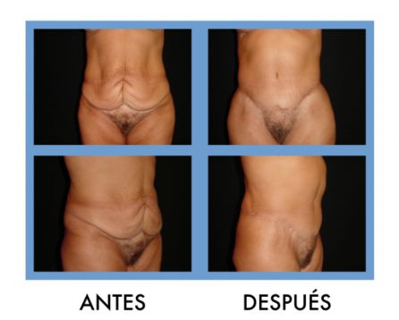 Antes y después de una abdominoplastia Antes y después de una abdominoplastia