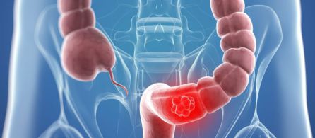Un estudio relaciona la carne roja con el cáncer de colon Un estudio relaciona la carne roja con el cáncer de colon