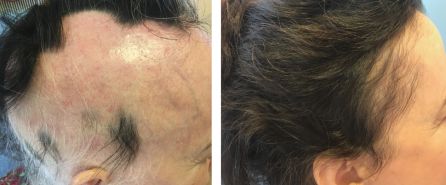 Alopecia areata en mujer de 51 años Alopecia areata en mujer de 51 años