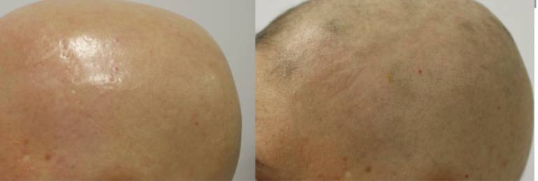 Mujer de 36 años con alopecia areata universal Mujer de 36 años con alopecia areata universal