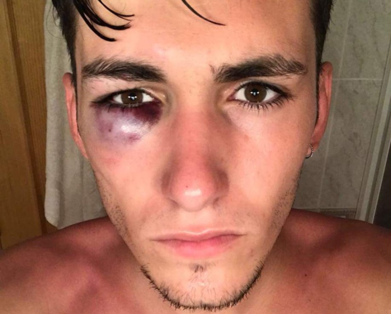 Un joven castellonense asegura que sufrió una brutal agresión en la playa durante el Arenal Sound Un joven castellonense asegura que sufrió una brutal agresión en la playa durante el Arenal Sound