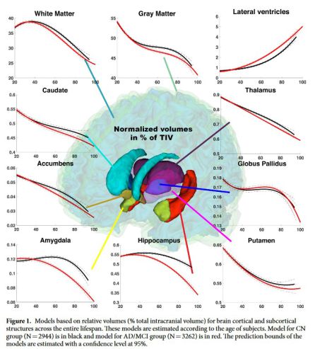 Evolución del alzhéimer en el cerebro Evolución del alzhéimer en el cerebro