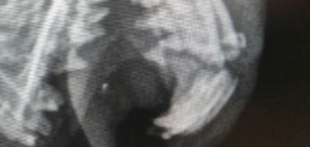 Radiografía en la que se ve la fractura Radiografía en la que se ve la fractura