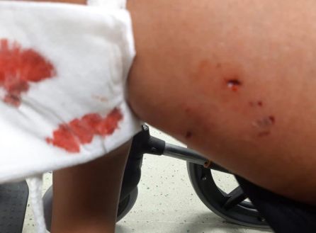 Heridas ocasionadas tras la mordedura del perro en Gandia a otra de las heridas. Heridas ocasionadas tras la mordedura del perro en Gandia a otra de las heridas.