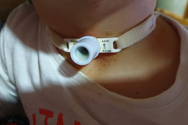 El pequeño Gabriel, de 3 años, sufre una traqueostomía desde que apenas tenía 20 días de edad El pequeño Gabriel, de 3 años, sufre una traqueostomía desde que apenas tenía 20 días de edad