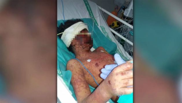 Un niño pierde la piel tras darle una dosis cuatro veces superior para tratar su epilepsia Un niño pierde la piel tras darle una dosis cuatro veces superior para tratar su epilepsia