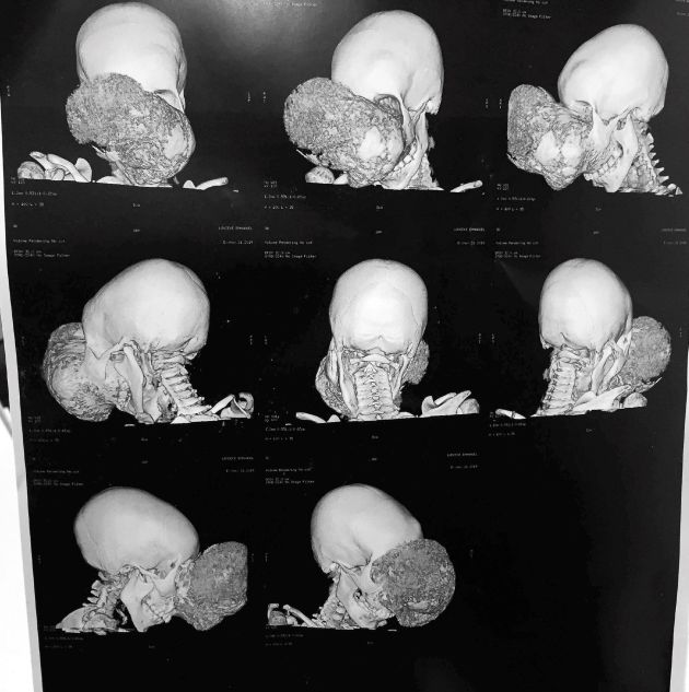 cirujano Pedro Cavadas ha extirpado un tumor cráneo facial no maligno que formaba una masa mas grande que su propia cabeza a Emmanuelle un niño congoleño de 10 años, que de no ser intervenido habría sufrido una muerte "en muy malas condiciones y relativamente pronto". En la imagen un TAC con diferentes imágenes del tumor de Emmanuelle antes de la intervención cirujano Pedro Cavadas ha extirpado un tumor cráneo facial no maligno que formaba una masa mas grande que su propia cabeza a Emmanuelle un niño congoleño de 10 años, que de no ser intervenido habría sufrido una muerte "en muy malas condiciones y relativamente pronto". En la imagen un TAC con diferentes imágenes del tumor de Emmanuelle antes de la intervención