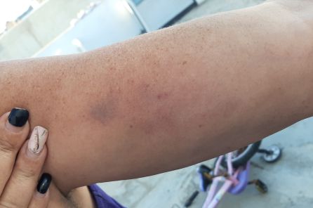 La madre del menor asegura que también tiene moratones al ser agarrada. La madre del menor asegura que también tiene moratones al ser agarrada.
