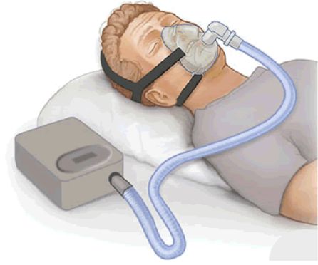 CPAP o máquina de presión positiva CPAP o máquina de presión positiva