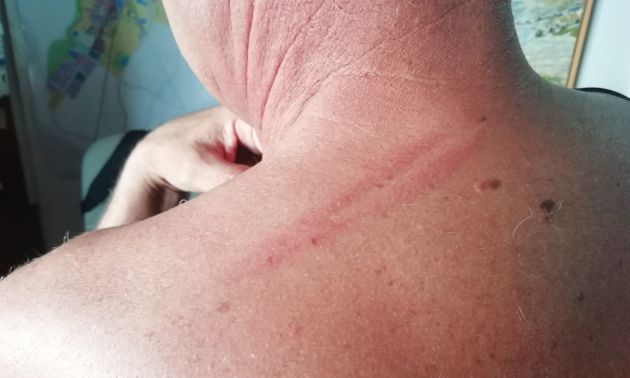 Estas son las heridas que sufrió en el cuello Estas son las heridas que sufrió en el cuello