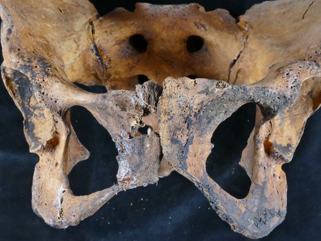 Imagen de la cadena de una mujer del antiguo egipto con el pubis alterado fruto del primer tratamiento ginecológico de la historia del que se tiene constancia Imagen de la cadena de una mujer del antiguo egipto con el pubis alterado fruto del primer tratamiento ginecológico de la historia del que se tiene constancia