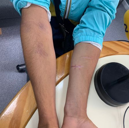 Toufik muestra los cortes en los brazos que le hizo el mismo hombre que le propinó una pedrada en la cabeza. Toufik muestra los cortes en los brazos que le hizo el mismo hombre que le propinó una pedrada en la cabeza.