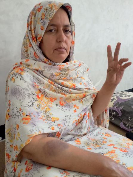 Sultana Jaya, en su vivienda del Sáhara Occidental, mostrando su brazo amoratado Sultana Jaya, en su vivienda del Sáhara Occidental, mostrando su brazo amoratado