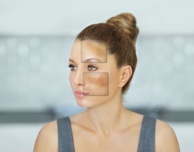 Melasma Melasma