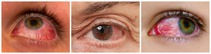 Efectos de la conjuntivitis. Efectos de la conjuntivitis.