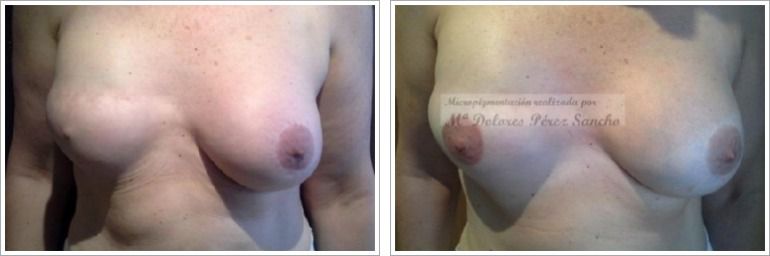 Una mujer antes y después de someterse a la micropigmentación en uno de sus pechos Una mujer antes y después de someterse a la micropigmentación en uno de sus pechos