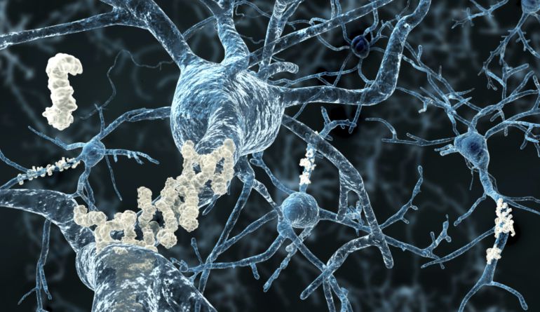 Neuronas recubiertas de proteína amiloide Neuronas recubiertas de proteína amiloide