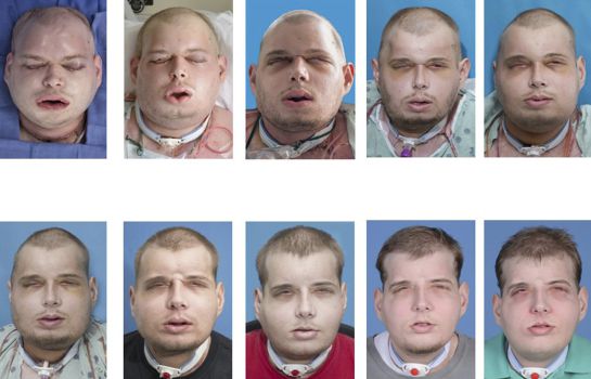 Volunteer firefighter Patrick Hardison, 41, of Senatobia, Mississippi is shown in this series of photos showing the progress of face transplant surgery in this undated handout provided by NYU Langone Medical Center in New York, November 16, 2015. Hardison, whose face was burned off during a rescue is the recipient of what surgeons called the most extensive face transplant ever, performed at a New York hospital. REUTERS/NYU Langone Medical Center/Handout via Reuters ATTENTION EDITORS - NOT FOR SALE FOR MARKETING OR ADVERTISING CAMPAIGNS. THIS IMAGE HAS BEEN SUPPLIED BY A THIRD PARTY. IT IS DISTRIBUTED, EXACTLY AS RECEIVED BY REUTERS, AS A SERVICE TO CLIENTS. EDITORIAL USE ONLY. NO RESALES. NO ARCHIVE Volunteer firefighter Patrick Hardison, 41, of Senatobia, Mississippi is shown in this series of photos showing the progress of face transplant surgery in this undated handout provided by NYU Langone Medical Center in New York, November 16, 2015. Hardison, whose face was burned off during a rescue is the recipient of what surgeons called the most extensive face transplant ever, performed at a New York hospital. REUTERS/NYU Langone Medical Center/Handout via Reuters ATTENTION EDITORS - NOT FOR SALE FOR MARKETING OR ADVERTISING CAMPAIGNS. THIS IMAGE HAS BEEN SUPPLIED BY A THIRD PARTY. IT IS DISTRIBUTED, EXACTLY AS RECEIVED BY REUTERS, AS A SERVICE TO CLIENTS. EDITORIAL USE ONLY. NO RESALES. NO ARCHIVE