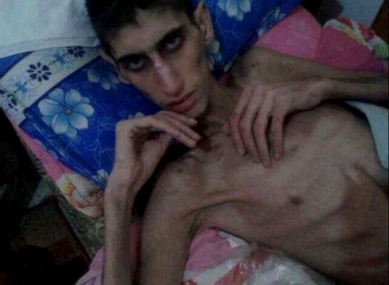 Un hombre demacrado como consecuencia del hambre que asola la localidad siria de Madaya.