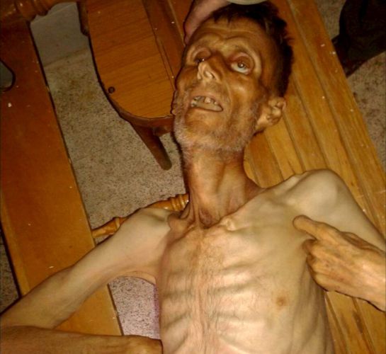 Un hombre esquelético como consecuencia del hambre que asola la localidad siria de Madaya.