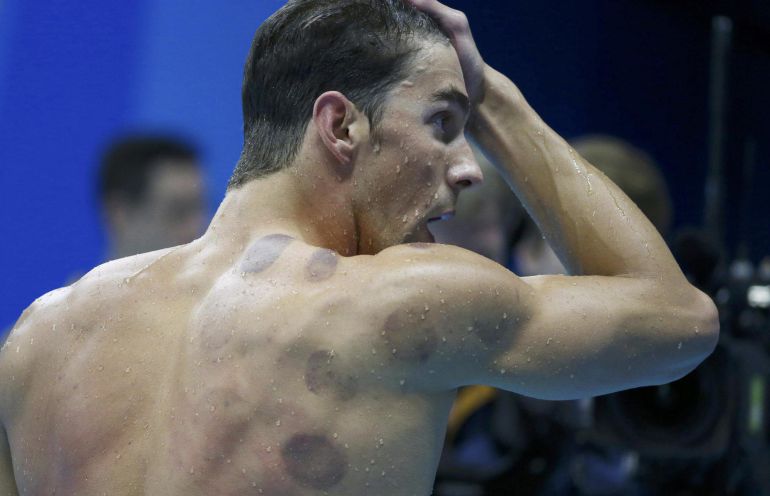 Imagen del nadador olímpico estadounidense Michael Phelps, en la que aparece la técnica cupping. Imagen del nadador olímpico estadounidense Michael Phelps, en la que aparece la técnica cupping.