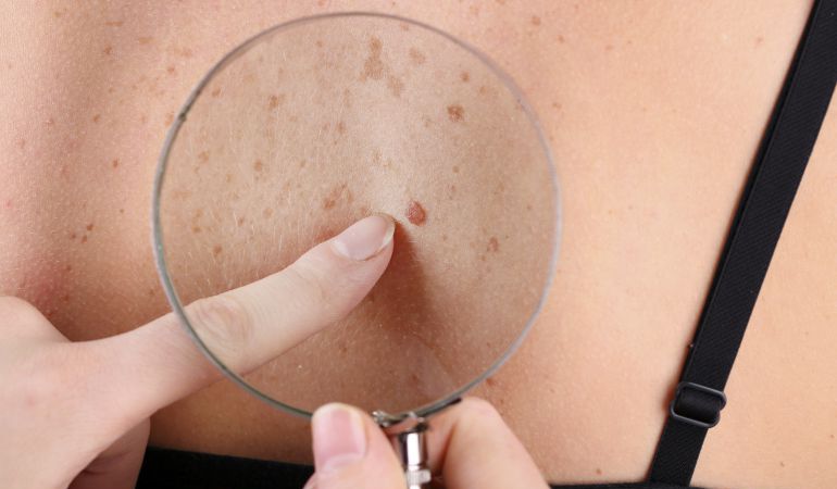 Crean un algoritmo que diagnostica cáncer de piel con la precisión de un dermatólogo