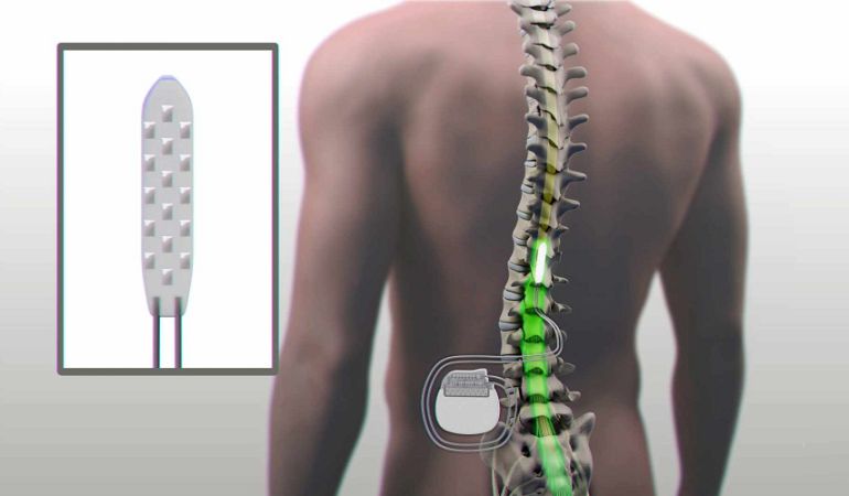 El dispositivo instalado en el cuerpo del paciente. El dispositivo instalado en el cuerpo del paciente.
