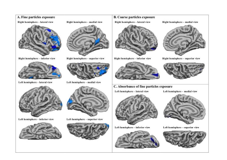 Esta imagen muestra las diferentes regiones del cerebro afectadas por contaminación del aire por partículas finas y gruesas que emiten, sobre todo, los coches.
Esta imagen muestra las diferentes regiones del cerebro afectadas por contaminación del aire por partículas finas y gruesas que emiten, sobre todo, los coches.