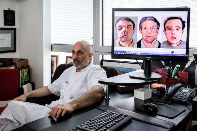 El francés padece neurofibromatosis-1 o enfermedad Von Recklinghausen, un mal genético que le provocó la deformación del rostro El francés padece neurofibromatosis-1 o enfermedad Von Recklinghausen, un mal genético que le provocó la deformación del rostro
