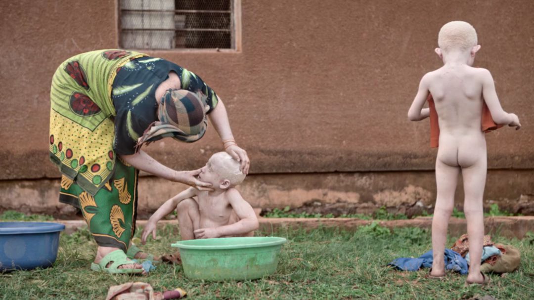Ser albino en Tanzania, en imágenes Ser albino en Tanzania, en imágenes