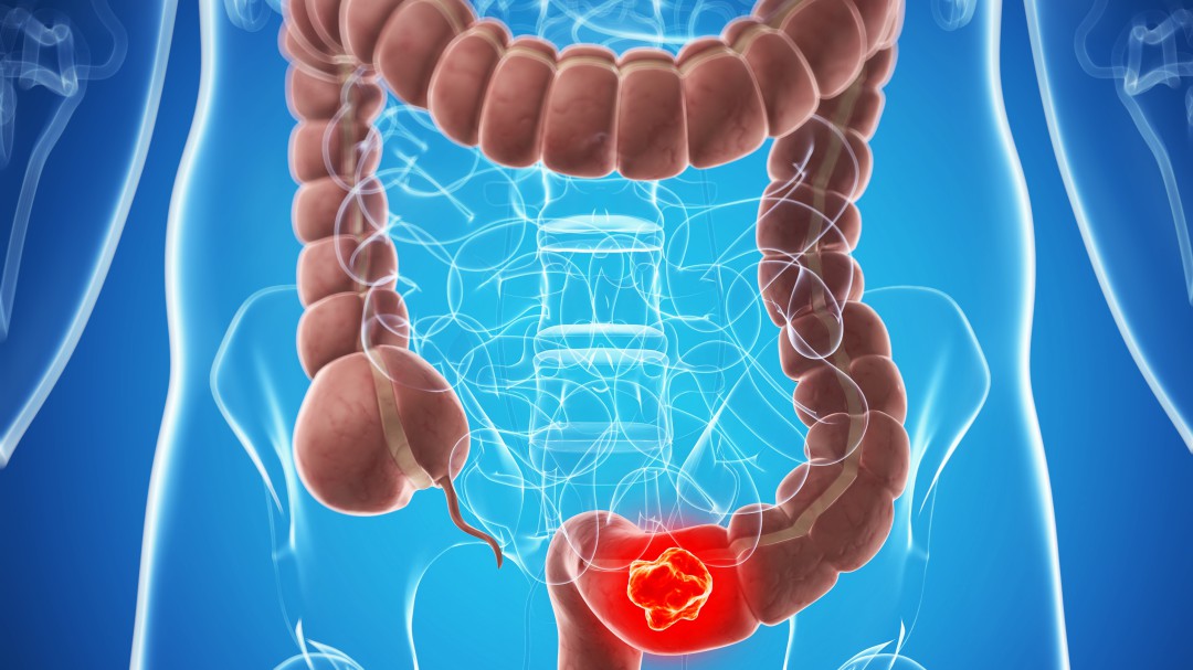 José Carlos Vicente: Quien tenga sospechas puede pedir la prueba de cribado de cáncer de colon