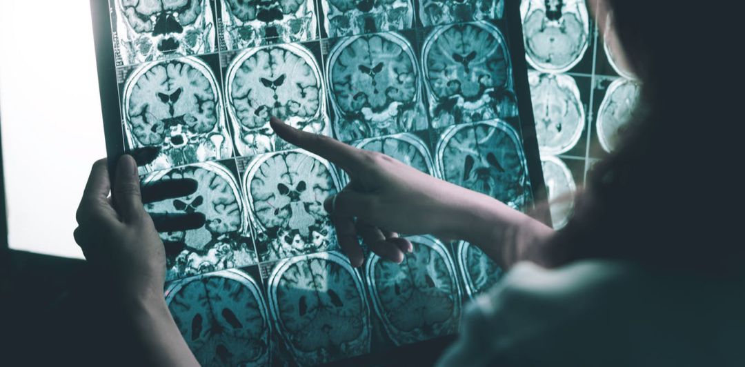 Alzhéimer: cada vez más evidencias apuntan al virus del herpes como posible causa