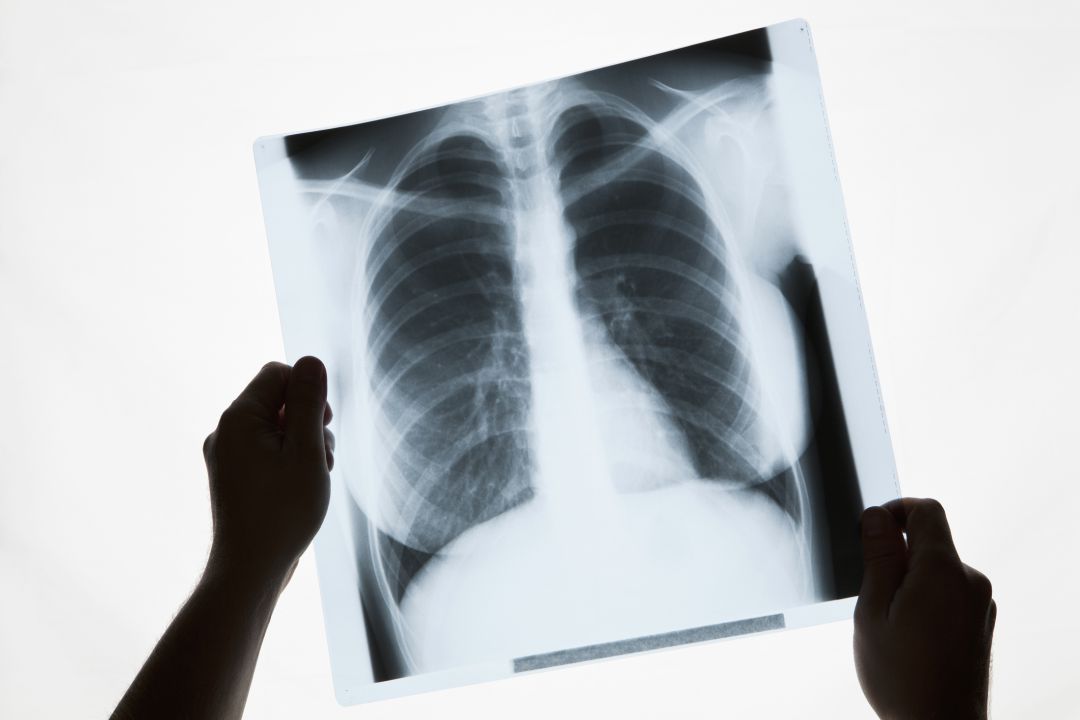 La victoria de Celestino, el hombre que congeló sus pulmones para demostrar que murió por el amianto La victoria de Celestino, el hombre que congeló sus pulmones para demostrar que murió por el amianto