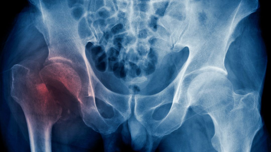 Solo el 50% de las fracturas de cadera se operan antes de las 48 horas Solo el 50% de las fracturas de cadera se operan antes de las 48 horas
