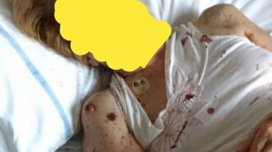 Encuentran a una paciente cubierta por hormigas en un hospital de Nápoles