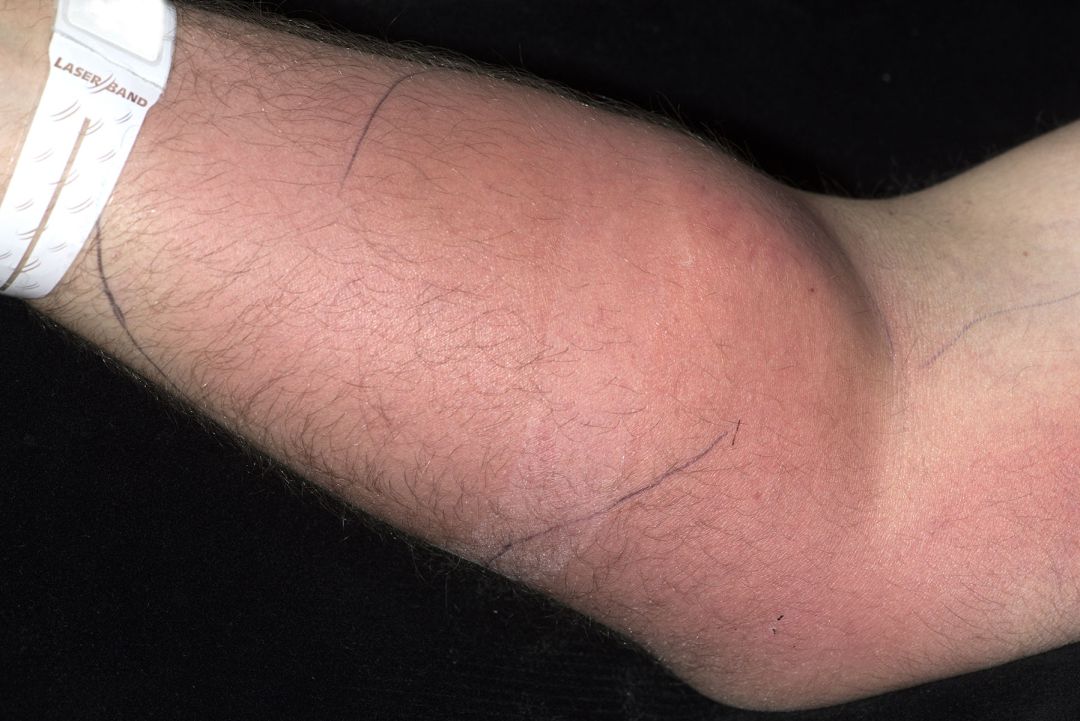El joven se inyectaba su semen como forma de curarse el dolor de espalda El joven se inyectaba su semen como forma de curarse el dolor de espalda