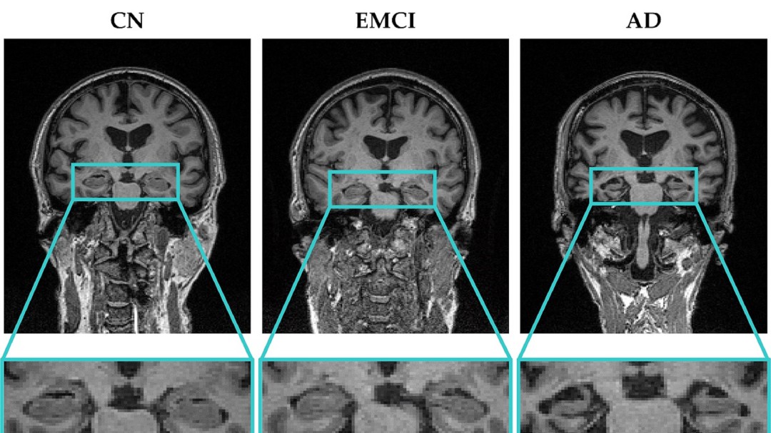 Una herramienta no invasiva para diagnosticar el Alzhéimer en fases más tempranas