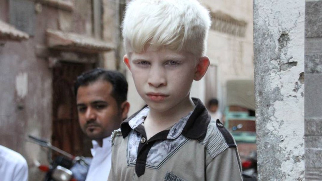 Una guía para docentes sobre los alumnos albinos