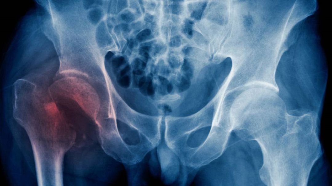 Entrevista con el traumatólogo del Hospital Universitario de Móstoles sobre las fracturas de cadera: Causas de las fracturas de cadera y como intentar prevenirlas Entrevista con el traumatólogo del Hospital Universitario de Móstoles sobre las fracturas de cadera: Causas de las fracturas de cadera y como intentar prevenirlas