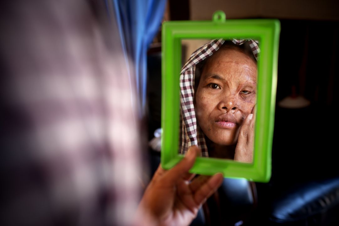 Una mujer víctima de un ataque con ácido en Camboya mira su cara a través de un espejo. Una mujer víctima de un ataque con ácido en Camboya mira su cara a través de un espejo.
